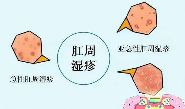 两个月肛周瘙痒，原因、症状与治疗方案